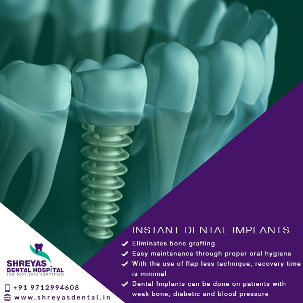 dental implants in Ahmedabad